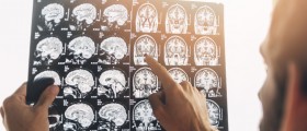 ALS Diagnosis: 6 Diagnostic Tests Doctors Use To Exclude Other Diseases and Diagnose ALS